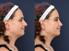 Unveiling the Artistry of Rhinoplasty in Dubai: A Gateway to Facial Harmony Rhinoplasty in Dubai