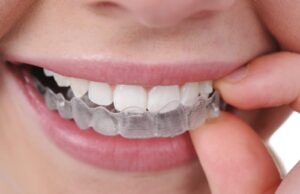 4 Questions To Ask Before Getting Invisalign® Getting Invisalign