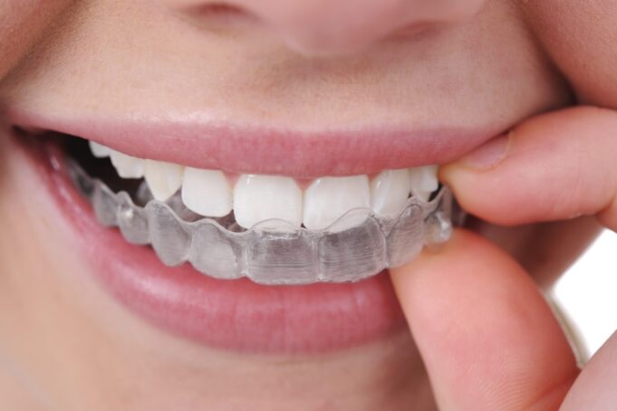 Getting Invisalign